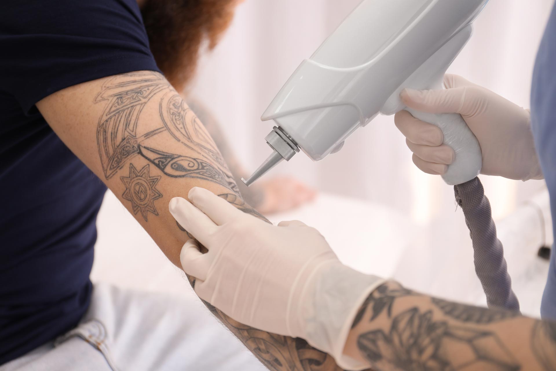 Tattoo entfernen lassen – Was tun, wenn die Tinte zur Qual wird?